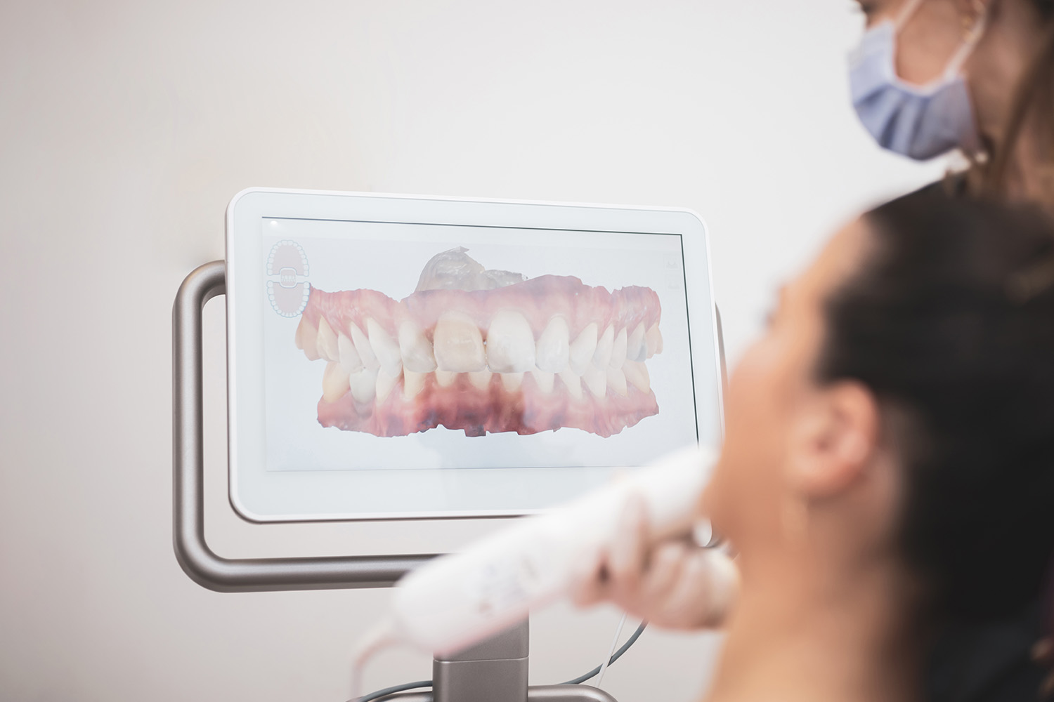 口腔内スキャナー