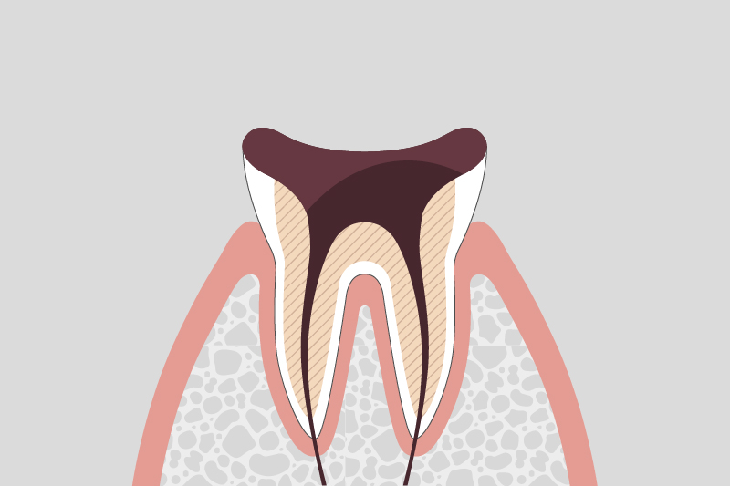 歯の根まで進行したむし歯