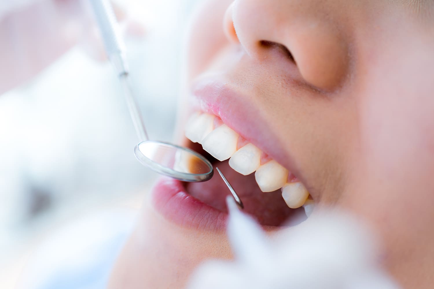 歯の神経を守る治療（MTAセメント・ダイレクトボンディング）