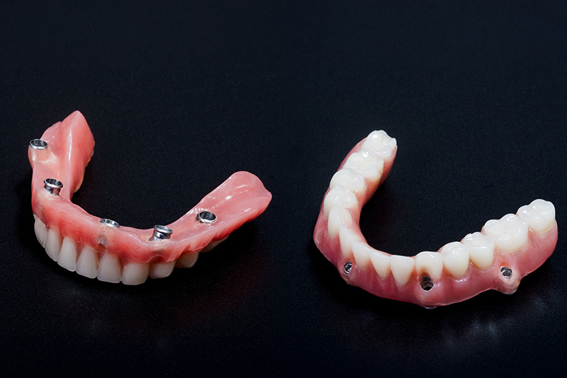 マグネット義歯