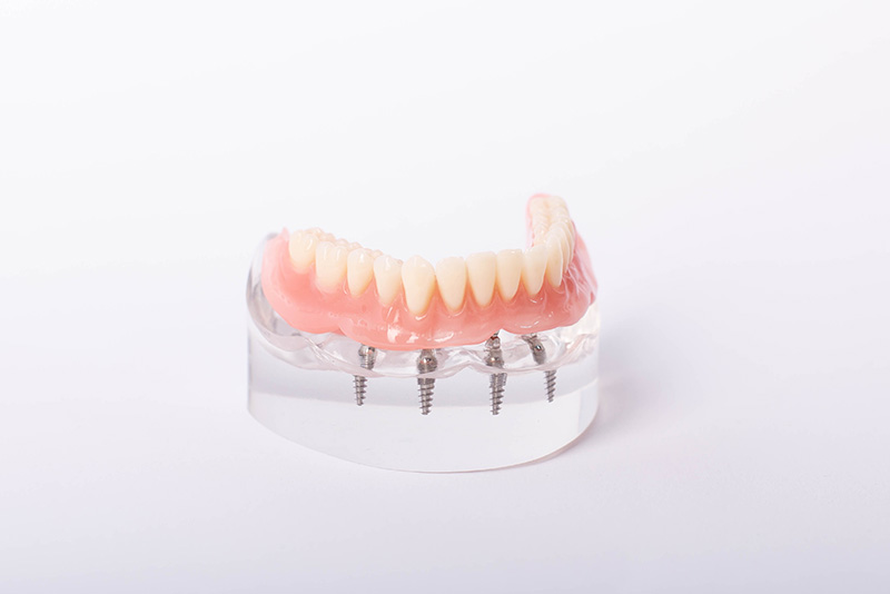 インプラントオーバーデンチャー