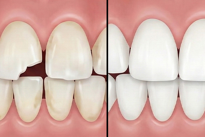 ダイレクトボンディング