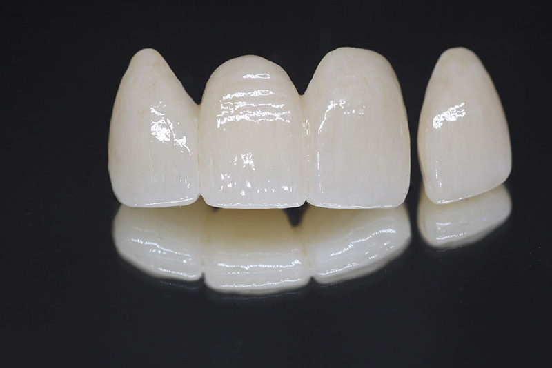 セラミックの詰め物・被せ物