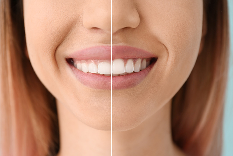 ガミースマイル治療