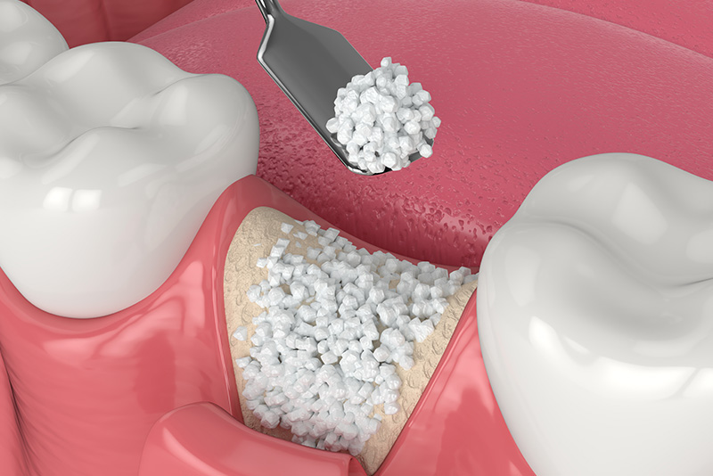 骨造成処置のイメージ