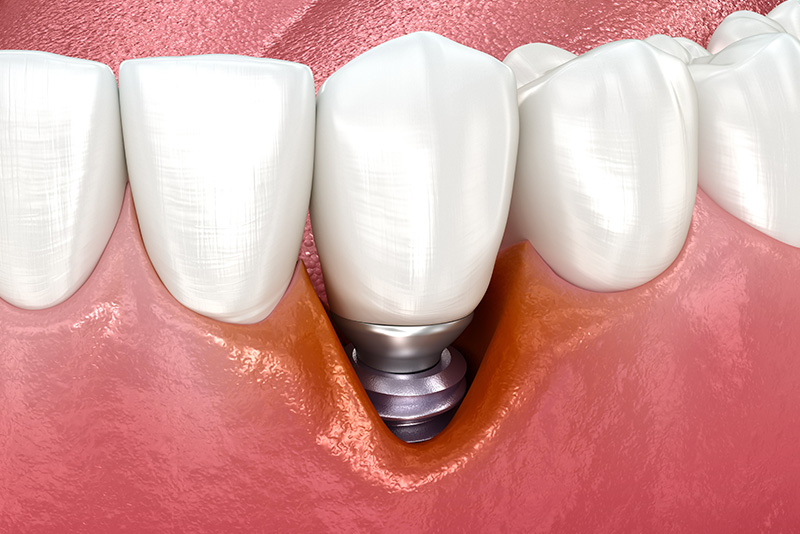 インプラント周囲炎の管理イメージ