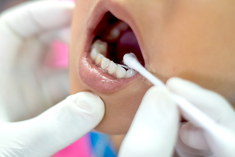 フッ素塗布とシーラント