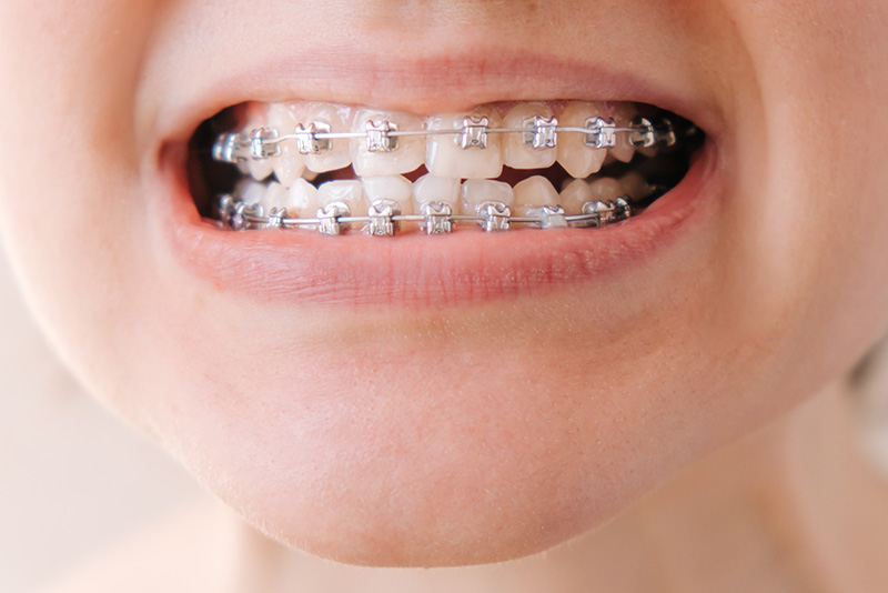 ブラケット矯正（ワイヤー矯正）