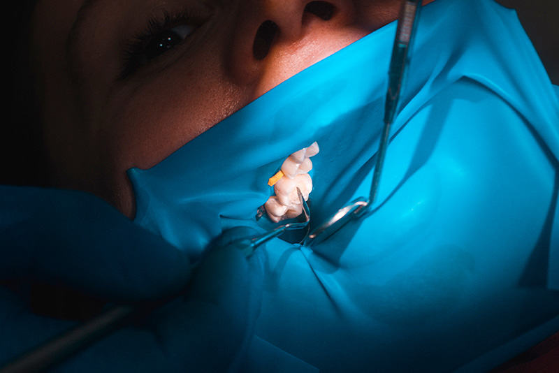 ラバーダムを使用した感染対策の場面