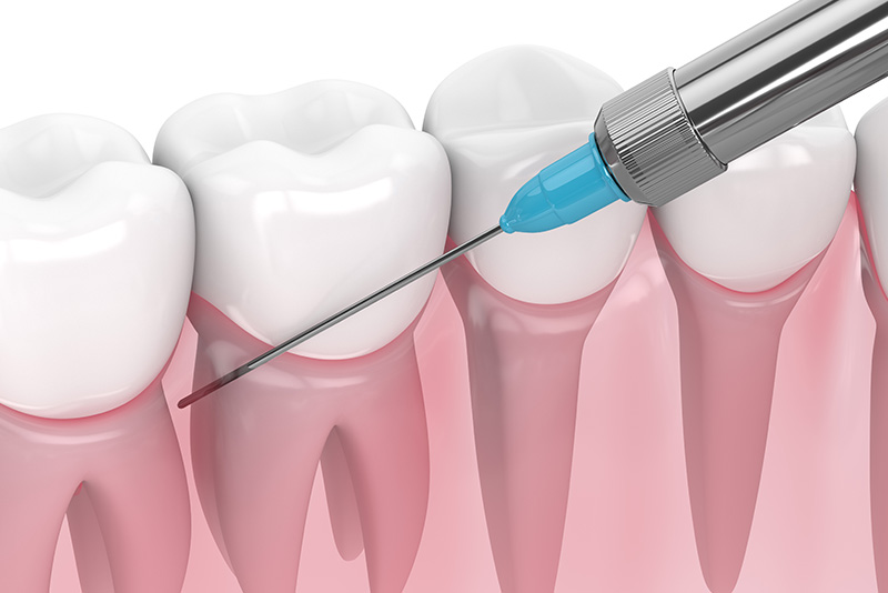 痛みに配慮した麻酔処置の場面