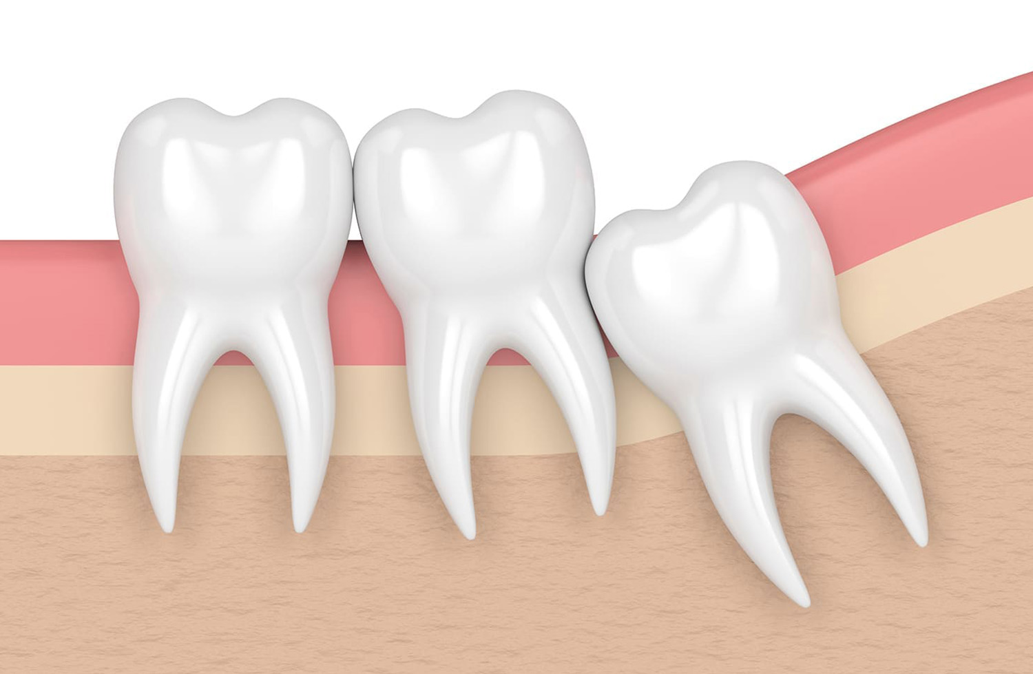 一般的な親知らずの抜歯