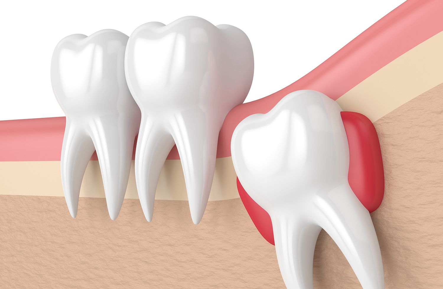 埋伏している親知らずの抜歯