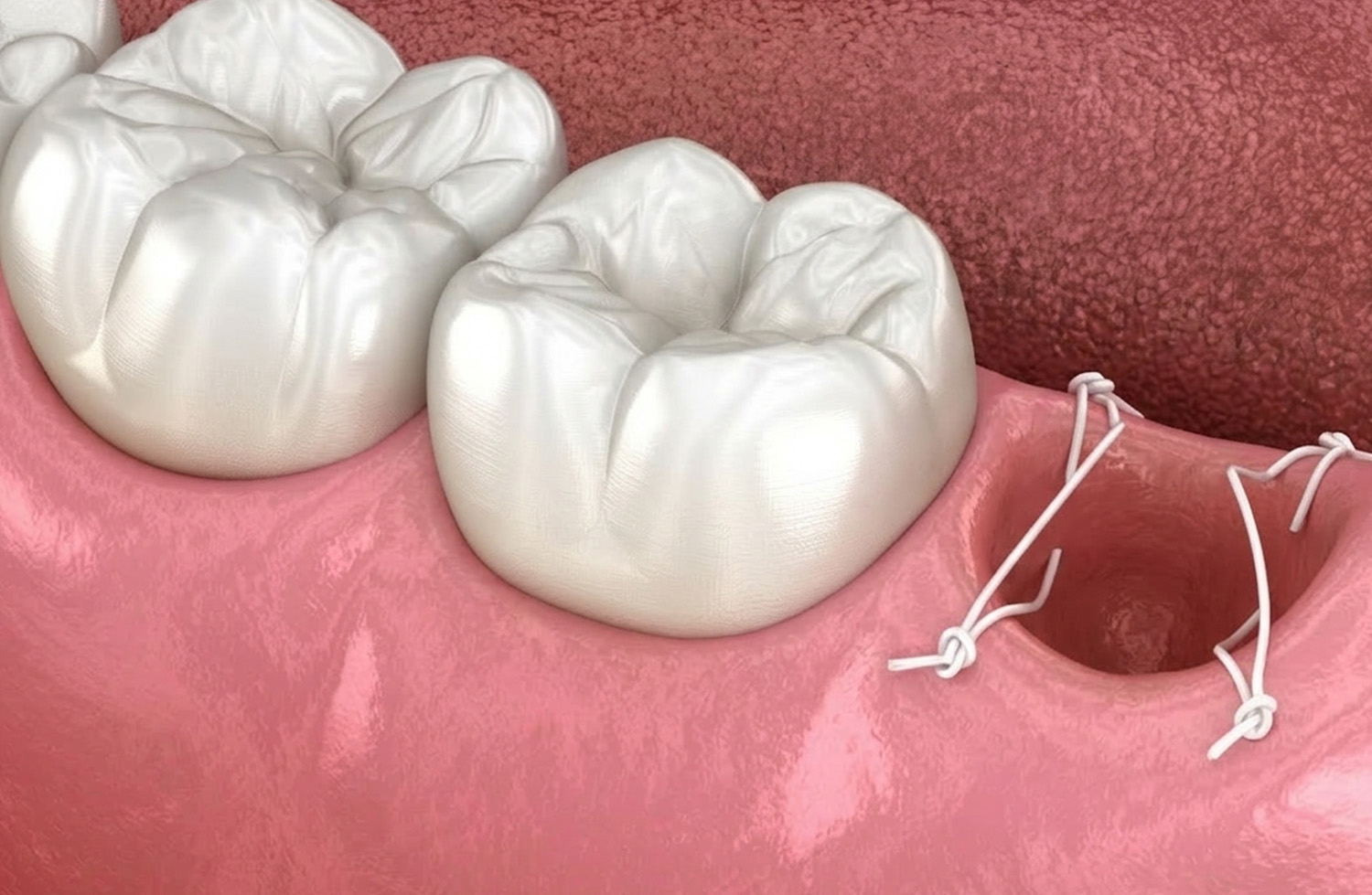 抜歯後の適切なケア