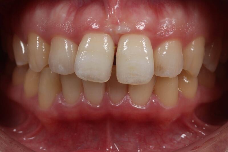 前歯のすき間(正中離開)をダイレクトボンディングで修復した症例