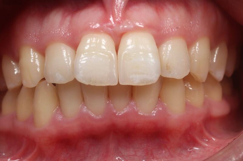 前歯のすき間(正中離開)をダイレクトボンディングで修復した症例