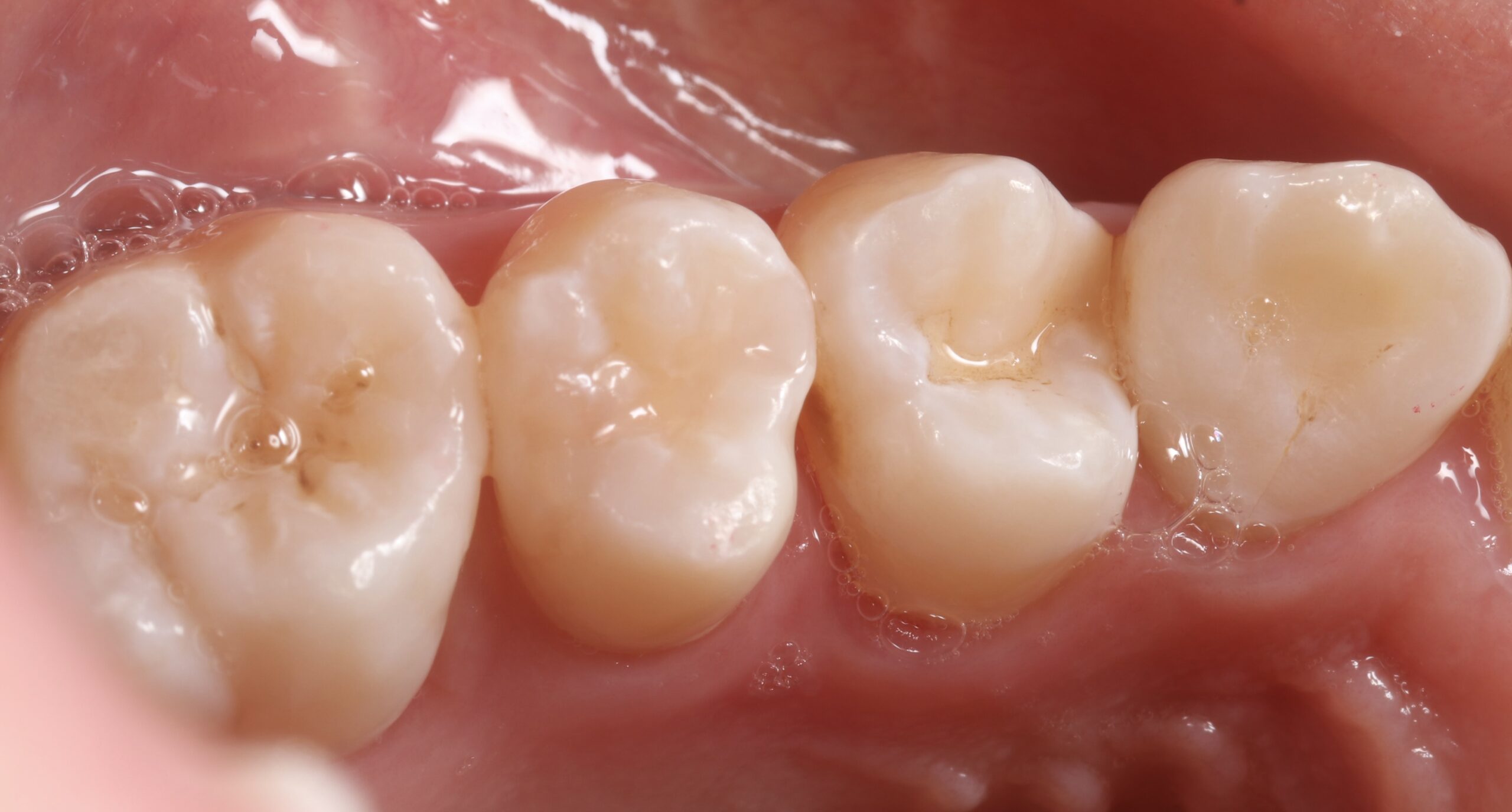 奥歯のむし歯をダイレクトボンディングで修復した症例