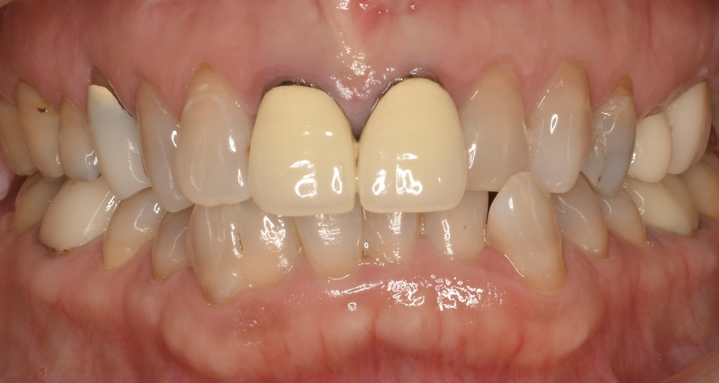 前歯をジルコニアクラウンで治療した症例