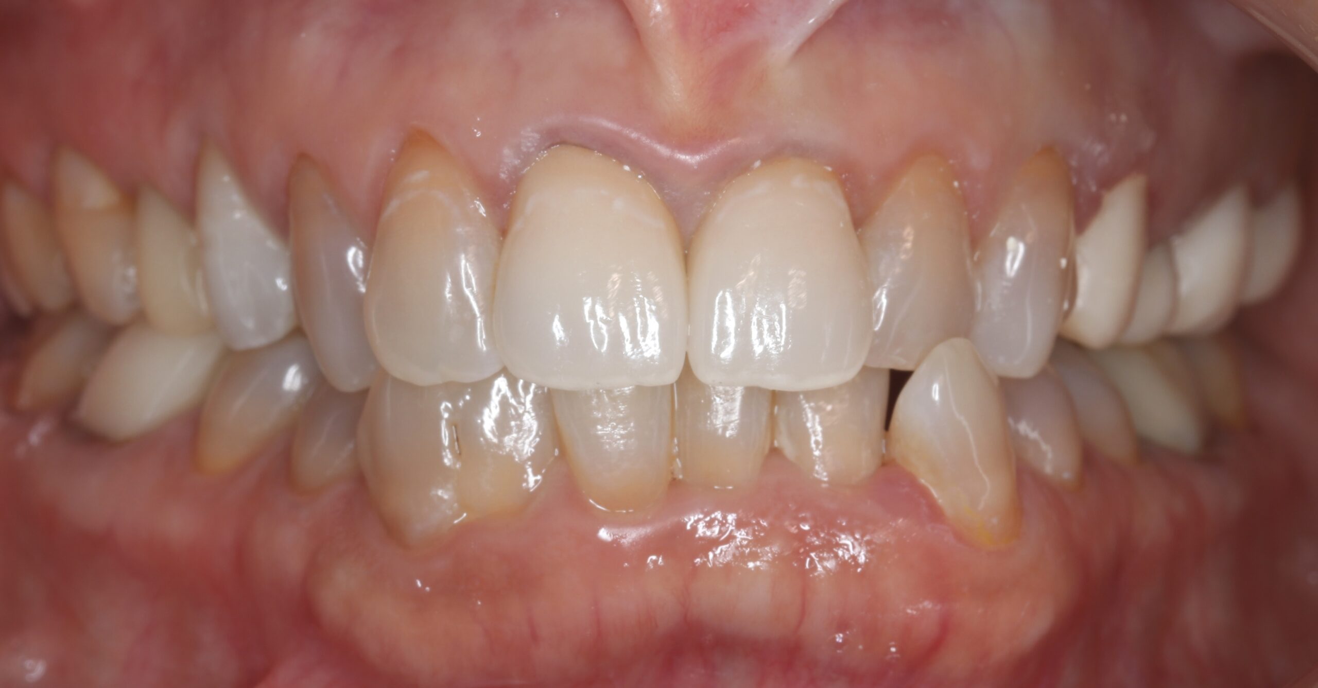 前歯をジルコニアクラウンで治療した症例