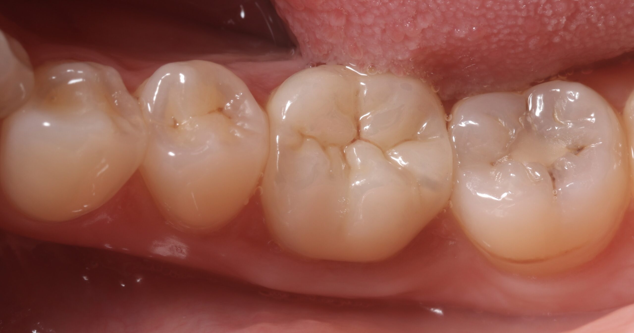 奥歯をジルコニアクラウンで治療した症例