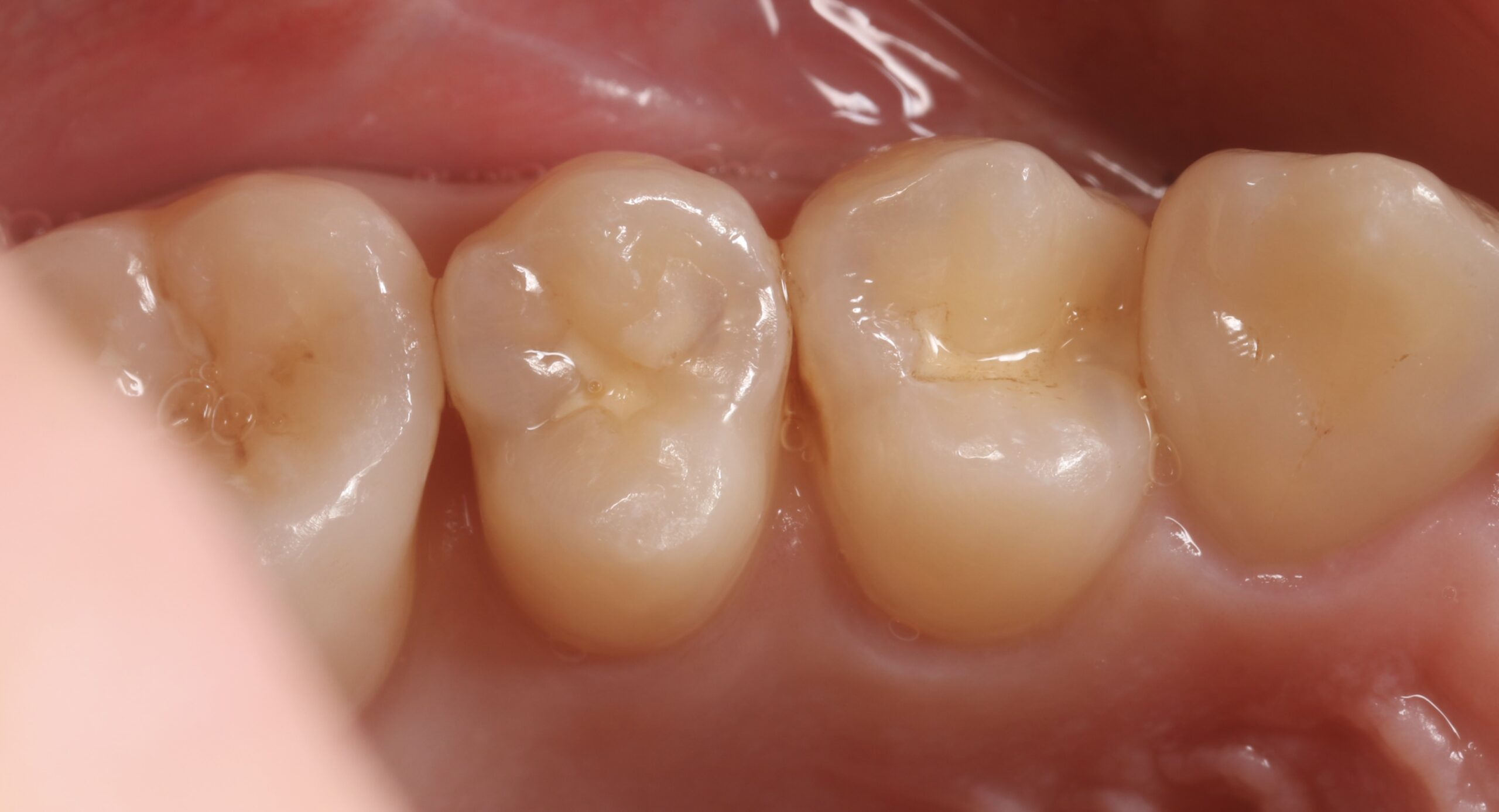 奥歯のむし歯をダイレクトボンディングで修復した症例