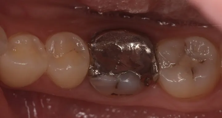 奥歯をジルコニアクラウンで治療した症例(治療前)